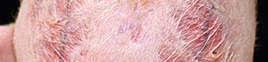 Dermatosis endócrina y metabólica