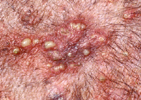 Photo of pústula